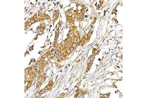 Immunohistochemistry of paraffin-embedded human breast cancer using UQCRH Rabbit mAb (ABIN7271126) at dilution of 1:50 (40x lens). (UQCRH Antikörper)