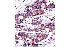 N Antibody (C-term) ((ABIN389343 and ABIN2839452))immunohistochemistry analysis in formalin fixed and paraffin embedded human colon carcinoma followed by peroxidase conjugation of the secondary antibody and DAB staining. (NPM1 Antikörper  (C-Term))