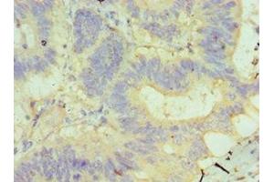 Immunohistochemistry of paraffin-embedded human colon cancer using ABIN7145506 at dilution of 1:100 (Glucuronidase beta Antikörper  (AA 382-651))