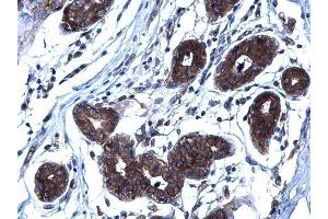 IHC-P Image RANKL antibody [C2C3], C-term detects RANKL protein at membrane on human breast carcinoma by immunohistochemical analysis. (RANKL Antikörper  (C-Term))