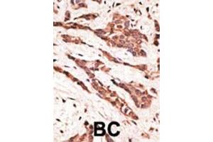 Formalin-fixed and paraffin-embedded human cancer tissue reacted with the primary antibody, which was peroxidase-conjugated to the secondary antibody, followed by AEC staining. (EDG4 Antikörper  (N-Term))