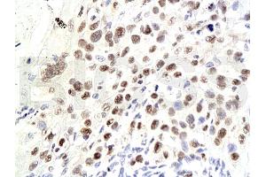 Formalin-fixed and paraffin embedded human laryngeal squamous cell carcinoma labeled Anti-P21/CDKN1A Polyclonal Antibody, Unconjugated (ABIN672606) at 1:200, followed by conjugation to the secondary antibody and DAB staining (p21 Antikörper  (AA 101-164))