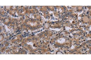 Immunohistochemistry of paraffin-embedded Human thyroid cancer using P2RX2 Polyclonal Antibody at dilution of 1:50 (P2RX2 Antikörper)