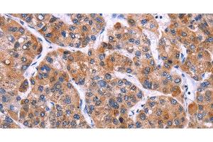 Immunohistochemistry of paraffin-embedded Human liver cancer tissue using MSMO1 Polyclonal Antibody at dilution 1:40 (SC4MOL Antikörper)