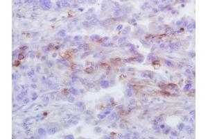 Formalin-fixed and paraffin embedded human lung carcinoma labeled with Rabbit Anti-CXCL1 Polyclonal Antibody, Unconjugated (ABIN2173443) at 1:200 followed by conjugation to the secondary antibody and DAB staining (CXCL1 Antikörper  (AA 51-107))