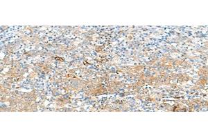 Immunohistochemistry of paraffin-embedded Human cervical cancer tissue using HLA-DRB3 Polyclonal Antibody at dilution of 1:50(x200) (HLA-DRB3 Antikörper)