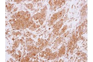 IHC-P Image Immunohistochemical analysis of paraffin-embedded human breast cancer, using RGS10, antibody at 1:250 dilution.