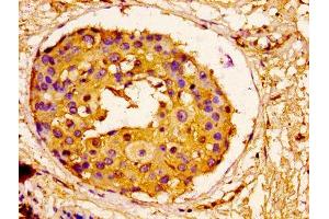 IHC image of ABIN7143742 diluted at 1:100 and staining in paraffin-embedded human breast cancer performed on a Leica BondTM system. (ORM1 Antikörper  (AA 19-201))