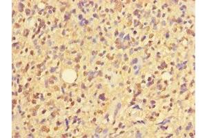 Immunohistochemistry of paraffin-embedded human glioma using ABIN7176377 at dilution of 1:100 (ZNF559 Antikörper  (AA 1-300))