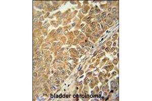 CR025 antibody immunohistochemistry analysis in formalin fixed and paraffin embedded human bladder carcinoma followed by peroxidase conjugation of the secondary antibody and DAB staining. (C18ORF25 Antikörper  (AA 163-191))