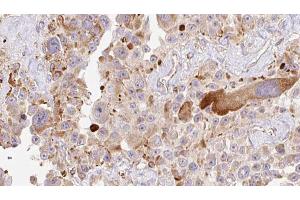 ABIN6274010 at 1/100 staining Human Melanoma tissue by IHC-P. (HAPLN1 Antikörper  (N-Term))