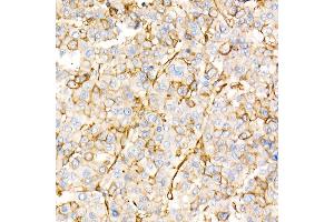 Immunohistochemistry of paraffin-embedded human liver cancer using Annexin  Rabbit pAb  at dilution of 1:25 (40x lens). (Annexin A2 Antikörper)