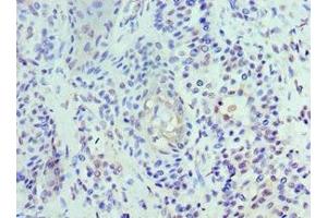 Immunohistochemistry of paraffin-embedded human breast cancer using ABIN7174459 at dilution of 1:100 (UBE2J2 Antikörper  (AA 1-230))