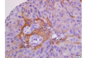 Formalin-fixed and paraffin embedded human laryngocarcinoma labeled with Anti-CK7 Polyclonal Antibody, Unconjugated  at 1:300 followed by conjugation to the secondary antibody and DAB staining. (Cytokeratin 7 Antikörper  (AA 251-350))