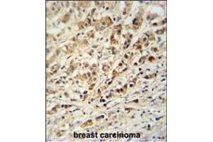 AVL9 Antibody (C-term) (ABIN651037 and ABIN2840044) immunohistochemistry analysis in formalin fixed and paraffin embedded human breast carcinoma followed by peroxidase conjugation of the secondary antibody and DAB staining. (AVL9 Antikörper  (C-Term))