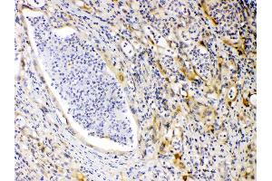 PRKAR1A was detected in paraffin-embedded sections of human intestinal cancer tissues using rabbit anti- PRKAR1A Antigen Affinity purified polyclonal antibody (Catalog # ) at 1 µg/mL. (PRKAR1A Antikörper  (AA 2-81))