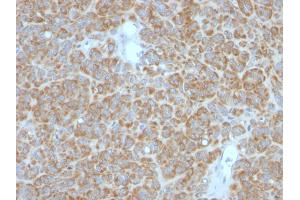Formalin-fixed, paraffin-embedded human Melanoma stained with Bcl-2 Monoclonal Antibody (BCL2/782 + BCL2/796). (Bcl-2 Antikörper)