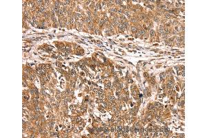 Immunohistochemistry of Human lung cancer using PDLIM4 Polyclonal Antibody at dilution of 1:30 (PDLIM4 Antikörper)