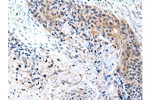 The image on the left is immunohistochemistry of paraffin-embedded Human esophagus cancer tissue using ABIN7190229(CFC1 Antibody) at dilution 1/20, on the right is treated with synthetic peptide. (CFC1 Antikörper)
