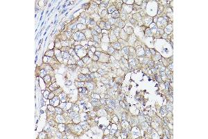 Immunohistochemistry of paraffin-embedded human breast cancer using MCT4/SLC16 Rabbit pAb (ABIN6129472, ABIN6147859, ABIN6147860 and ABIN6214836) at dilution of 1:100 (40x lens).