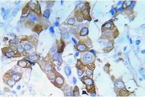 Immunohistochemistry (IHC) analyzes of p-IGF1R antibody in paraffin-embedded human lung adenocarcinoma tissue. (IGF1R Antikörper  (pTyr980))