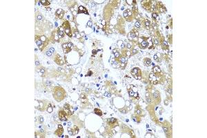 Immunohistochemistry of paraffin-embedded human liver damage using IL4 antibody (ABIN6128137, ABIN6142396, ABIN6142397 and ABIN6221290) at dilution of 1:100 (40x lens). (IL-4 Antikörper  (AA 25-153))