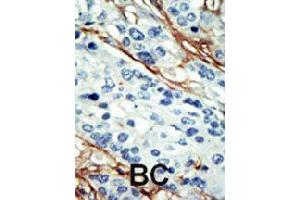Formalin-fixed and paraffin-embedded human cancer tissue reacted with NUAK1 polyclonal antibody  , which was peroxidase-conjugated to the secondary antibody, followed by DAB staining. (NUAK1 Antikörper  (C-Term))