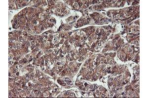 Immunohistochemical staining of paraffin-embedded Carcinoma of Human liver tissue using anti-HDHD1 mouse monoclonal antibody. (HDHD1 Antikörper)