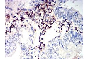 Immunohistochemical analysis of paraffin-embedded endometrial cancer tissues using CD352 mouse mAb with DAB staining. (SLAMF6 Antikörper  (AA 22-226))