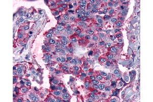 Anti-FZD5 / Frizzled 5 antibody IHC of human Lung, Non-Small Cell Carcinoma. (FZD5 Antikörper  (Cytoplasmic Domain))