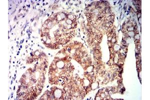 Immunohistochemical analysis of paraffin-embedded rectal cancer tissues using CDX2 mouse mAb with DAB staining. (CDX2 Antikörper  (AA 1-180))