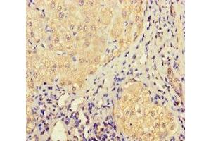 Immunohistochemistry of paraffin-embedded human liver cancer using ABIN7158316 at dilution of 1:100 (LHFPL1 Antikörper  (AA 21-85))