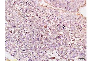 Formalin-fixed and paraffin embedded human colon carcinoma tissue labeled with Anti BACH1/BRIP1 Polyclonal Antibody,Unconjugated (ABIN753718) at 1:200 followed by conjugation to the secondary antibody and DAB staining. (BRIP1 Antikörper)
