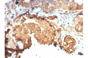 Formalin-fixed, paraffin-embedded human Breast Carcinoma stained with GRP94 Recombinant Rabbit Monoclonal Antibody (HSP90B1/3168R). (Rekombinanter GRP94 Antikörper)