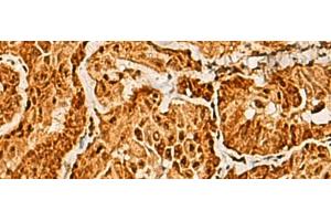 Immunohistochemistry of paraffin-embedded Human thyroid cancer tissue using SAP30BP Polyclonal Antibody at dilution of 1:40(x200) (SAP30BP Antikörper)