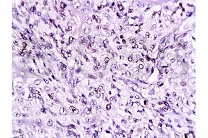 Formalin-fixed and paraffin embedded human breast carcinoma labeled Anti-Cyclin D3 Polyclonal Antibody, Unconjugated (ABIN671571) at 1:200, followed by conjugation to the secondary antibody and DAB staining (Cyclin D3 Antikörper  (AA 121-220))