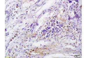 Formalin-fixed and paraffin embedded human cervical carcinoma labeled with Anti-CD146/MCAM Polyclonal Antibody, Unconjugated (ABIN732143) at 1:200 followed by conjugation to the secondary antibody and DAB staining (MCAM Antikörper  (AA 201-300))
