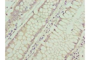 Immunohistochemistry of paraffin-embedded human colon cancer using ABIN7144195 at dilution of 1:100