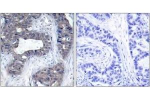 Immunohistochemistry analysis of paraffin-embedded human breast carcinoma tissue, using IRS-1 (Ab-307) Antibody. (IRS1 Antikörper  (AA 274-323))