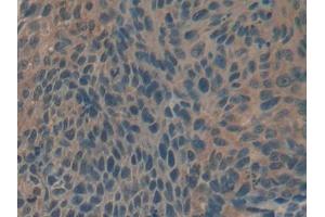 IHC-P analysis of Human Esophagus cancer Tissue, with DAB staining. (Biglycan Antikörper  (AA 243-369))