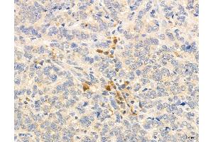 ABIN6264457 and ABIN6272976 at 1/100 staining Human breast cancer by IHC-P. (PSAT1 Antikörper  (Internal Region))