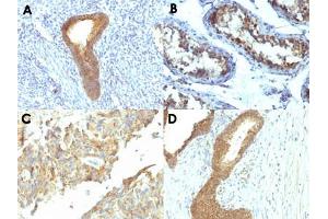 Immunohistochemical staining (Formalin-fixed paraffin-embedded sections) of human endometrial carcinoma (A), human testicular carcinoma (B), human ovarian carcinoma (C) and human colon carcinoma (D) with ALPL monoclonal antibody, clone ALPL/597 . (ALPL Antikörper)
