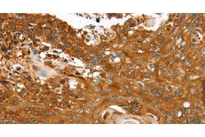 Immunohistochemistry of paraffin-embedded Human esophagus cancer tissue using ABCC8 Polyclonal Antibody at dilution 1:40 (ABCC8 Antikörper)