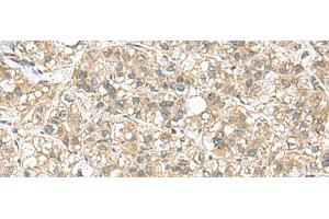 Immunohistochemistry of paraffin-embedded Human liver cancer tissue using PAPSS2 Polyclonal Antibody at dilution of 1:95(x200) (PAPSS2 Antikörper)