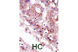 Formalin-fixed and paraffin-embedded human hepatocellular carcinoma tissue reacted with STK33 polyclonal antibody  , which was peroxidase-conjugated to the secondary antibody, followed by DAB staining. (STK33 Antikörper  (C-Term))