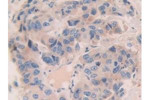 Detection of CNTN4 in Human Breast cancer Tissue using Polyclonal Antibody to Contactin 4 (CNTN4) (Contactin 4 Antikörper  (AA 731-980))