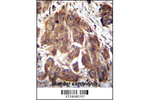 GLMN Antibody immunohistochemistry analysis in formalin fixed and paraffin embedded human bladder carcinoma followed by peroxidase conjugation of the secondary antibody and DAB staining. (GLMN Antikörper  (C-Term))