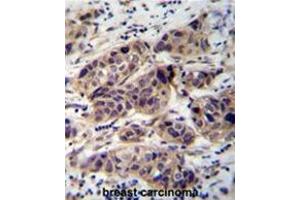 WDR42C Antibody (N-term) immunohistochemistry analysis in formalin fixed and paraffin embedded human breast carcinoma followed by peroxidase conjugation of the secondary antibody and DAB staining. (DCAF8L2 Antikörper  (N-Term))