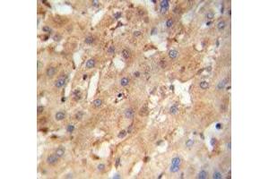 NEU4 antibody immunohistochemistry analysis in formalin fixed and paraffin embedded human hepatocarcinoma. (Sialidase 4 Antikörper  (AA 423-452))