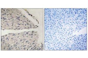 Immunohistochemistry analysis of paraffin-embedded human cervix carcinoma tissue using CIDEB antibody. (CIDEB Antikörper  (Internal Region))